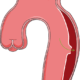 Disección aórtica