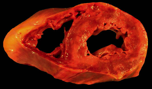 Miocarditis no infecciosa