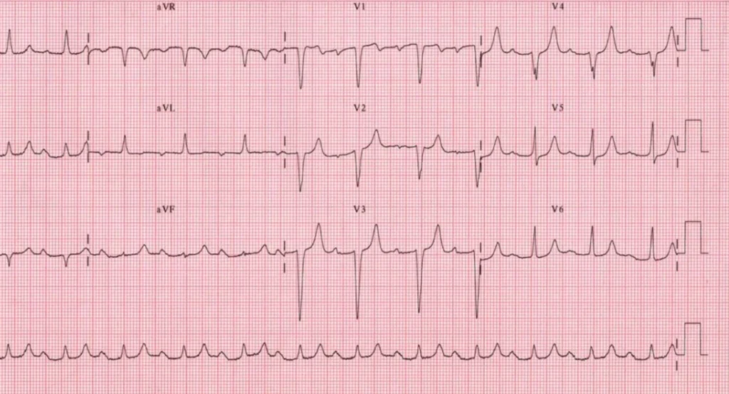 Bloqueo auriculoventricular (AV)