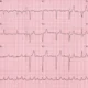 Bloqueo auriculoventricular (AV)