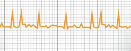 Diagnóstico de la fibrilación atrial