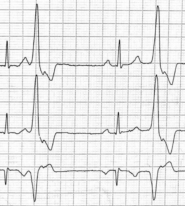 Latidos ventriculares prematuros