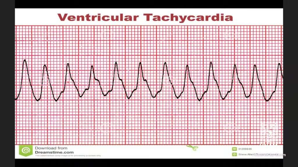Taquicardia ventricular