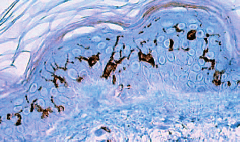 ¿Qué son las Células de Langerhans?