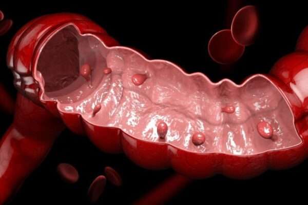 ¿Qué son los pólipos del colon?
