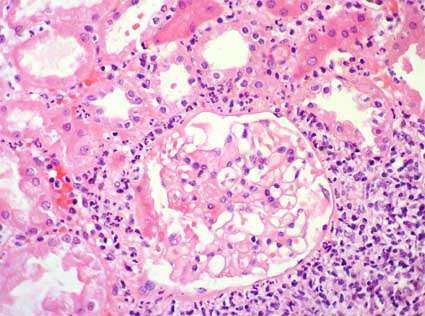 Enfermedad tubulointersticial crónica