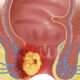 Abscesos y fístula perianal