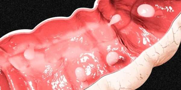 Pólipos adenomatosos y serrados no familiares