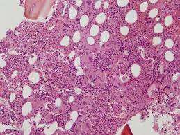 Mielofibrosis primaria