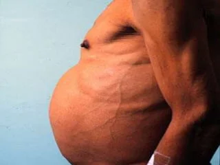 Fisiopatogénia de la ascitis refractaria