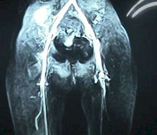 Oclusión arterial aguda de una extremidad