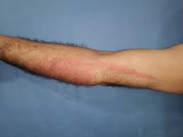 Linfangitis y la linfadenitis