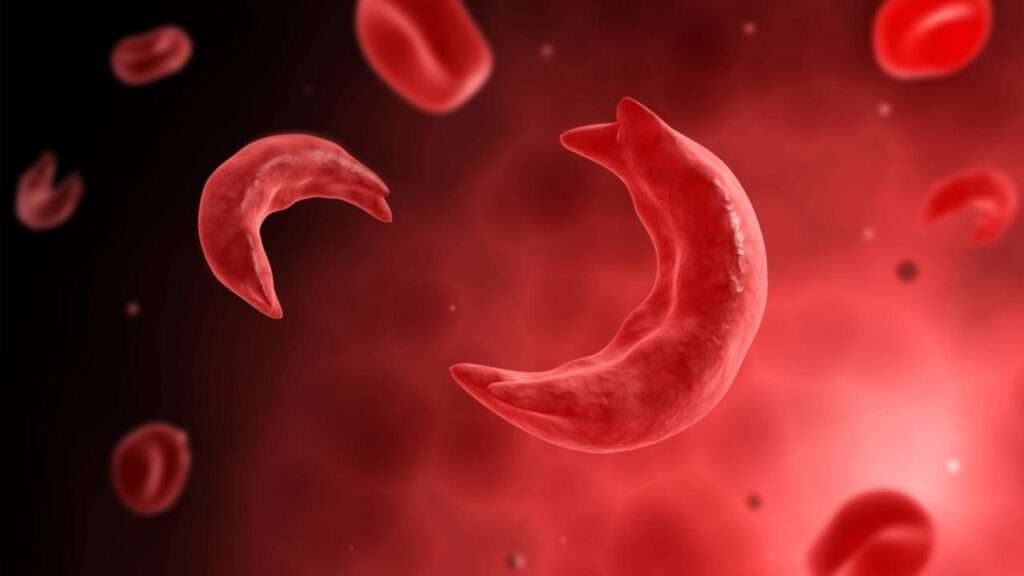 Anemia de células falciformes