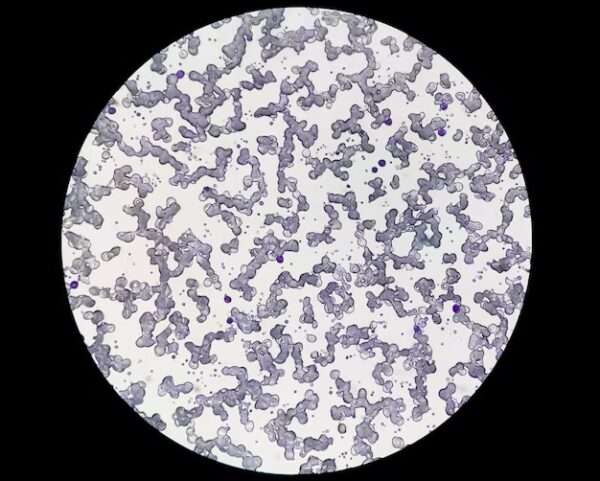 Enfermedad por aglutininas frías