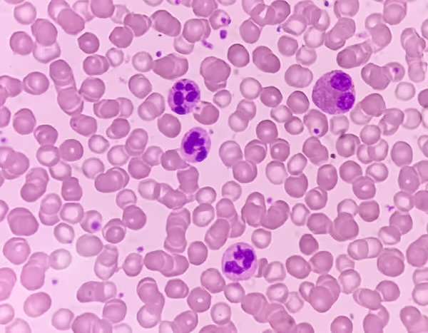 Neutropenia