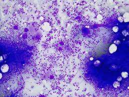 Trombocitosis esencial