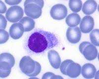 Leucemia de células pilosas