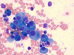 Mieloma de células plasmáticas