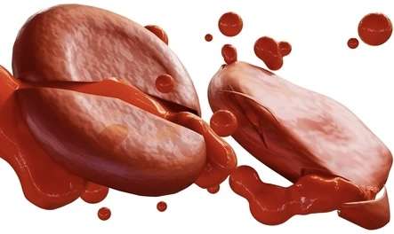 Reacciones hemolíticas a la transfusión