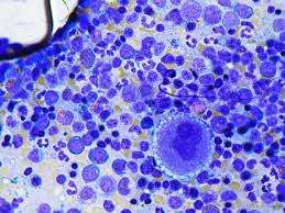 Infiltración de la médula ósea como causa de trombocitopenia