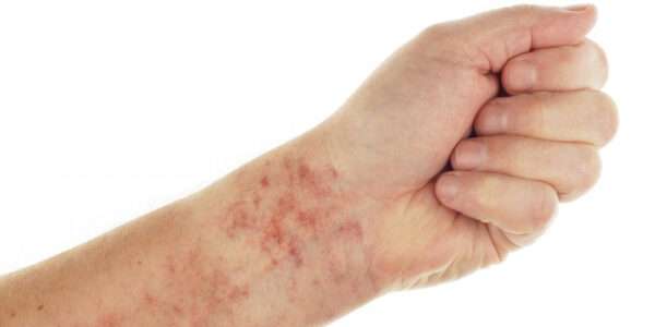 ¿Qué es la trombocitopenia cíclica?