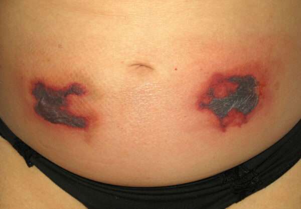 Trombocitopenia inducida por heparina