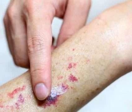 Trombocitopenia debida a fármacos