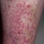 ¿Qué es la purpura posttransfusional?