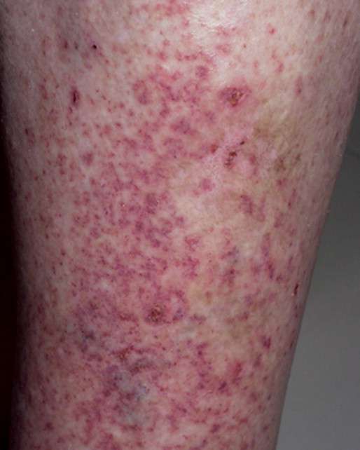 ¿Qué es la purpura posttransfusional?