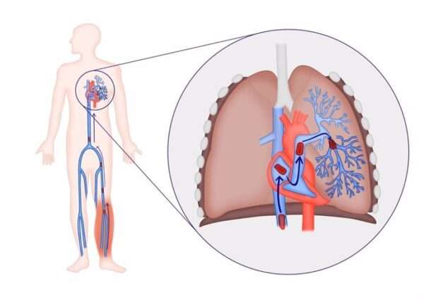 Estratificación de riesgos para la terapia anticoagulante inicial adecuada para la enfermedad tromboembólica venosa