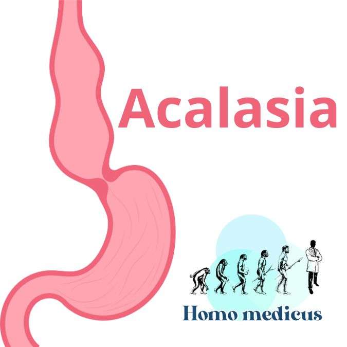Acalasia