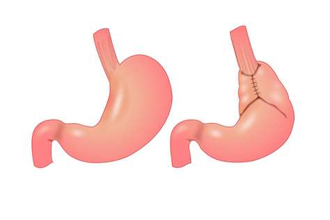 Tratamiento quirúrgico del la enfermedad por reflujo gastroesofágico