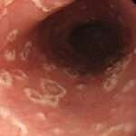 Esofagitis infecciosa