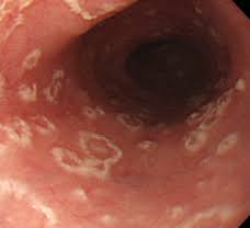 Esofagitis infecciosa