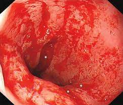 Síndrome de Mallory-Weiss