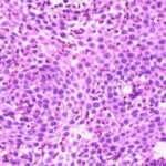 Esofagitis eosinofílica