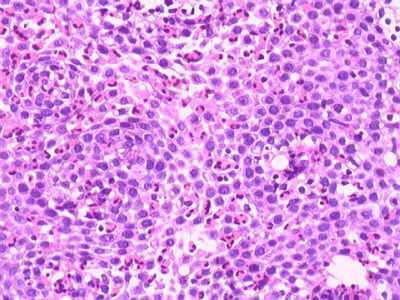 Esofagitis eosinofílica