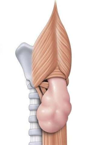 Divertículo de Zenker