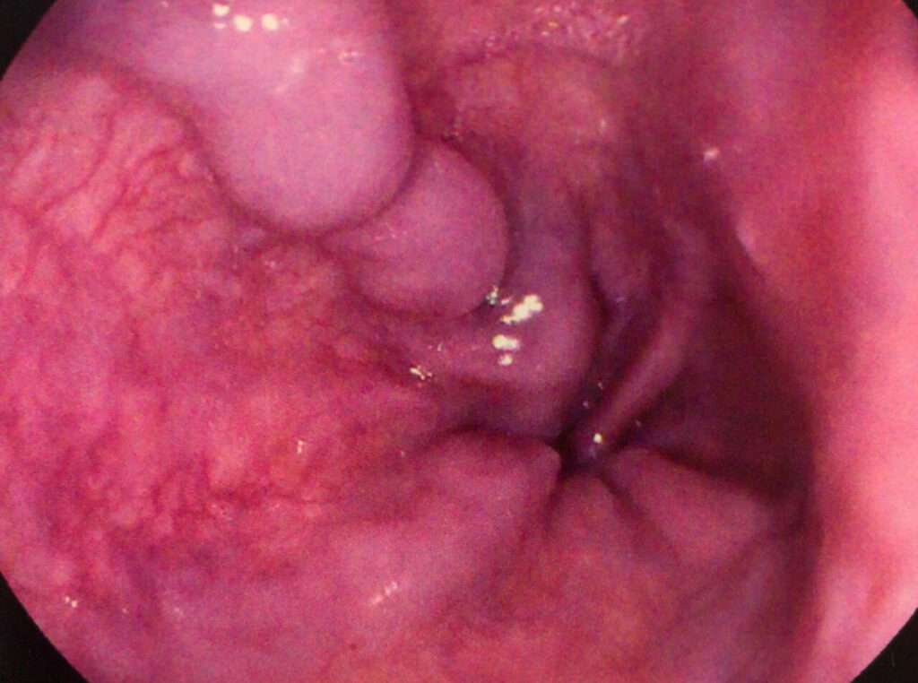 Manifestaciones clínicas de las Varices esofágicas