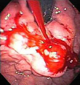 Manejo inicial de las várices esofágicas