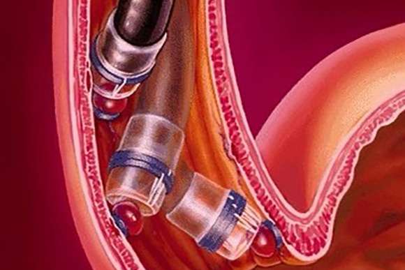 Prevención del resangrado de varices esofágicas