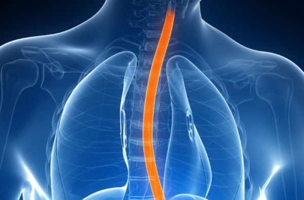 Trastornos primarios de la motilidad esofágica