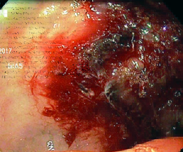 Gastropatía erosiva y hemorrágica