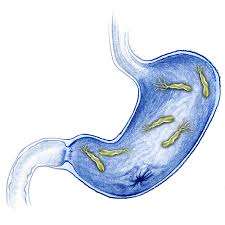 Gastritis por Helicobacter pylori