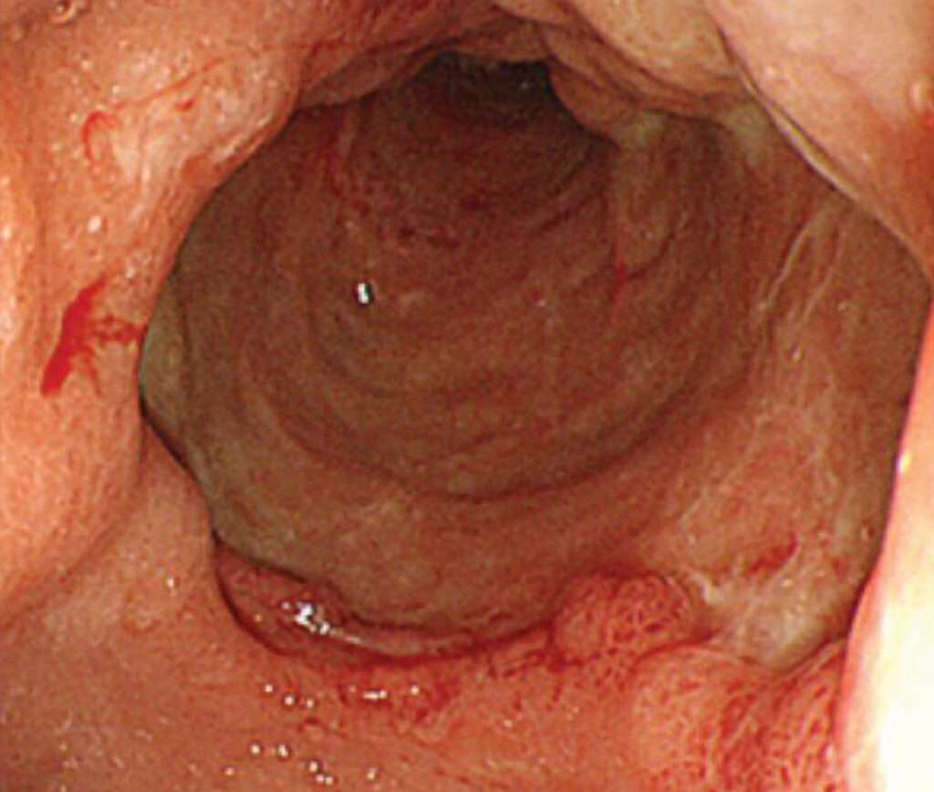 Gastritis flemonosa