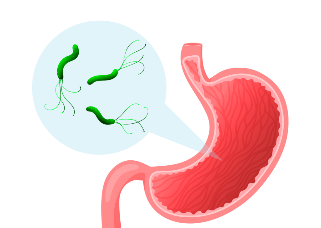 Úlceras asociadas a Helicobacter pylori
