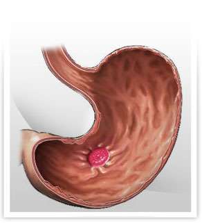 Úlceras inducidas por AINEs