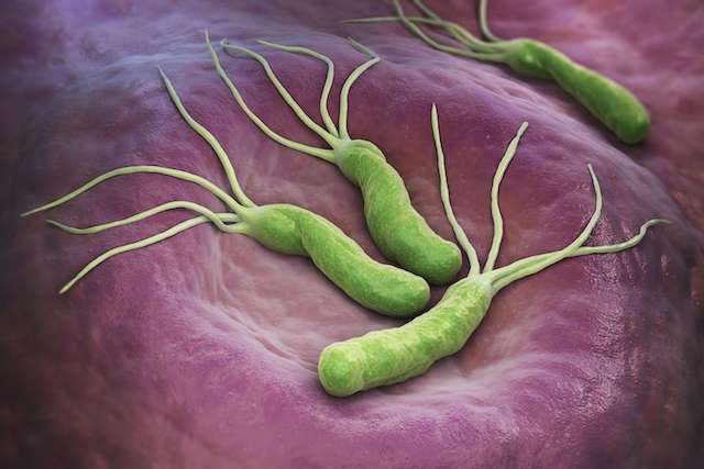 Tratamiento de las úlceras asociadas a Helicobacter pylori
