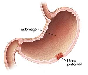 Úlcera gastroduodenal perforada