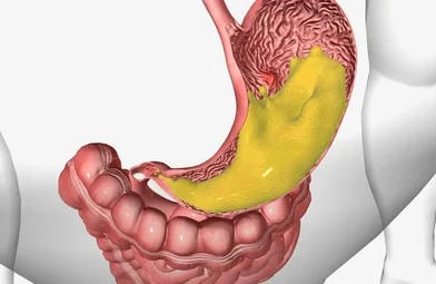 Obstrucción de salida gástrica secundaria a úlcera